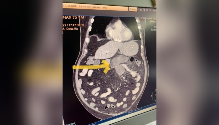 Black Fungus In Small Intestine