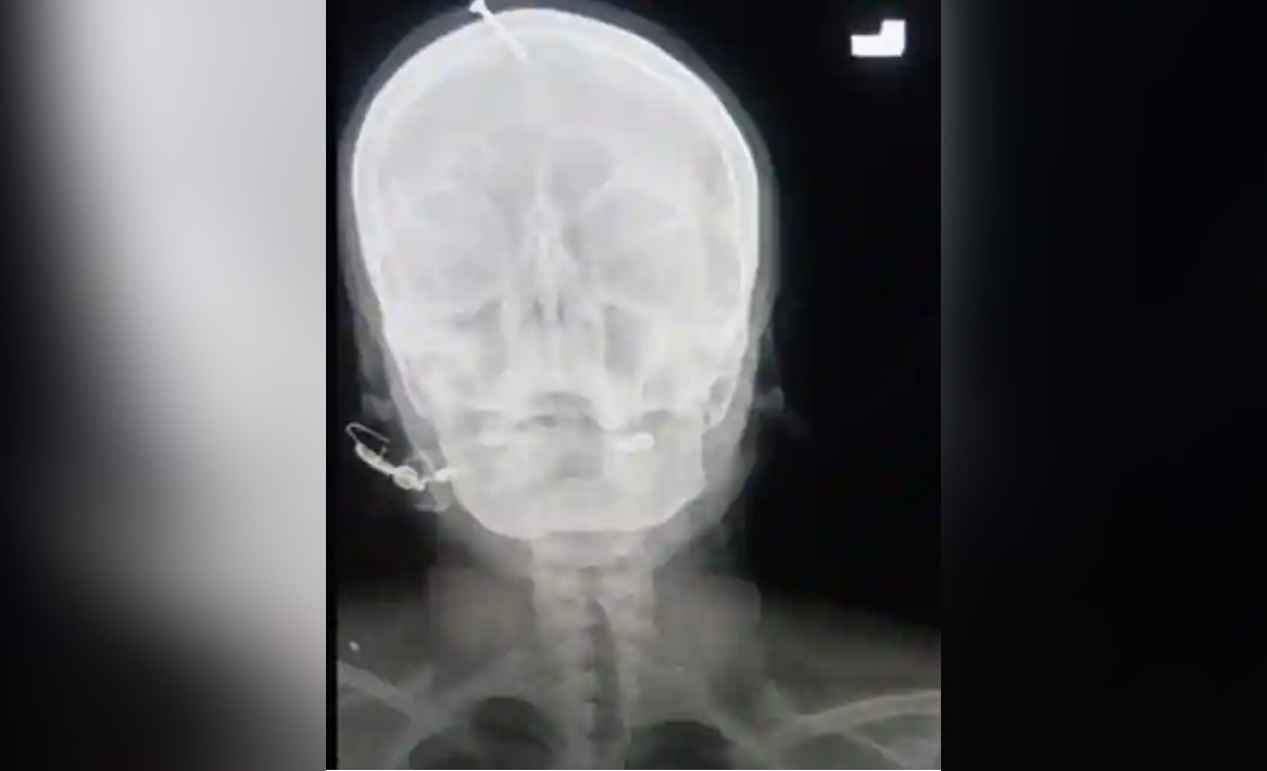 Nail hammered into the head of woman in Pakistan