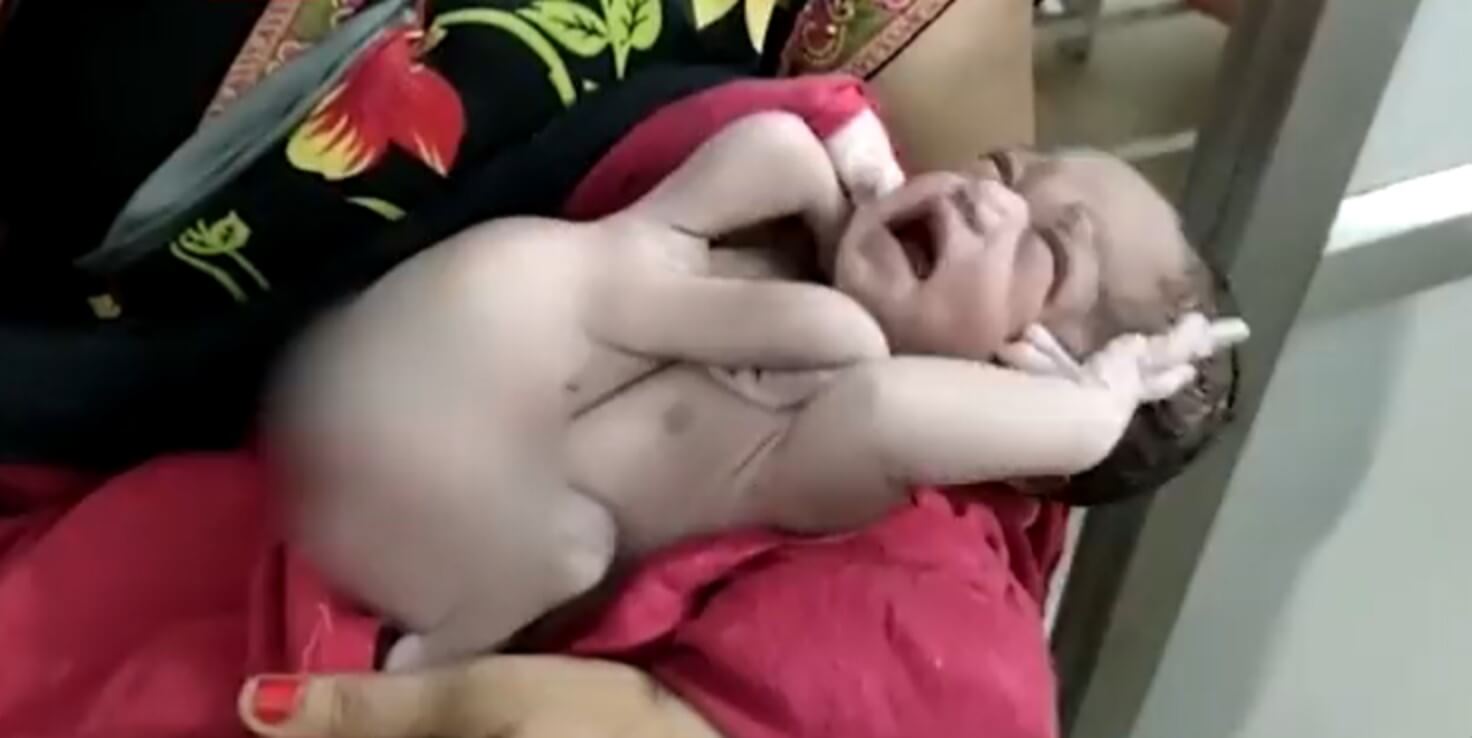 Baby with four legs and four hands (1)