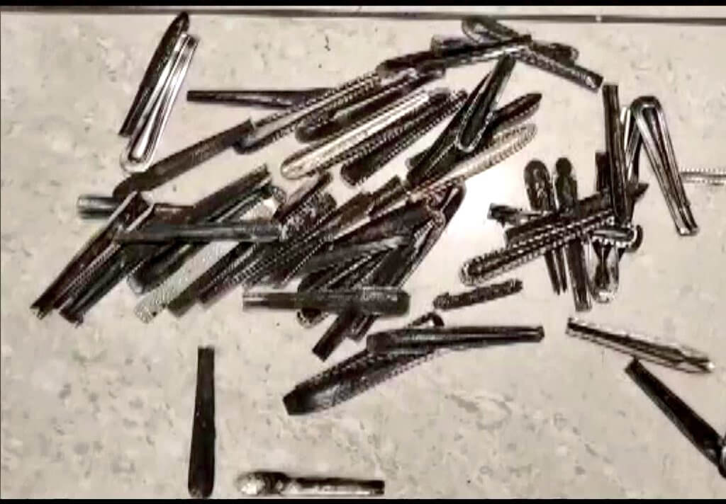 63 spoons found from mans stomach