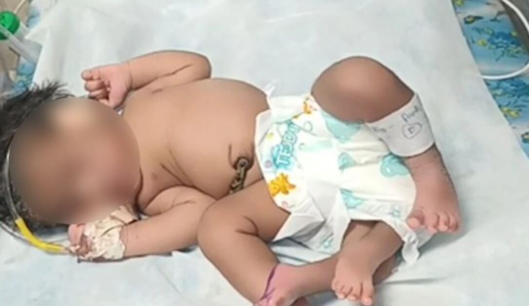 Girl born in Gwalior with 4 legs (1) (1)