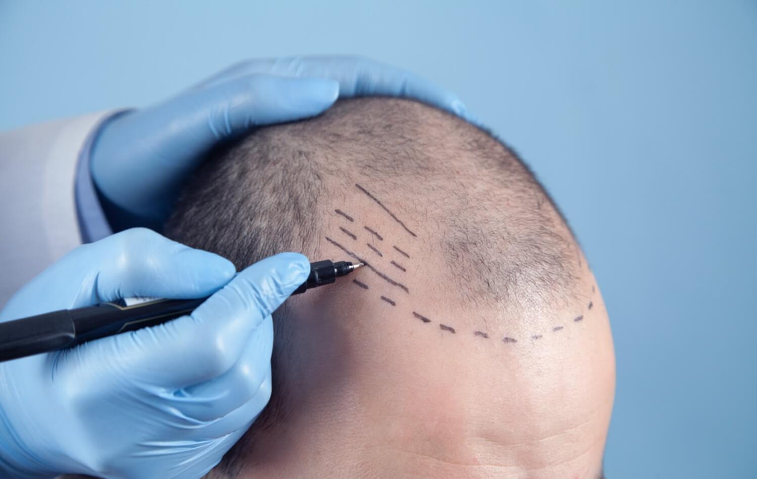 Hair Transplant Depositphotos_523489676_S (1) (1)