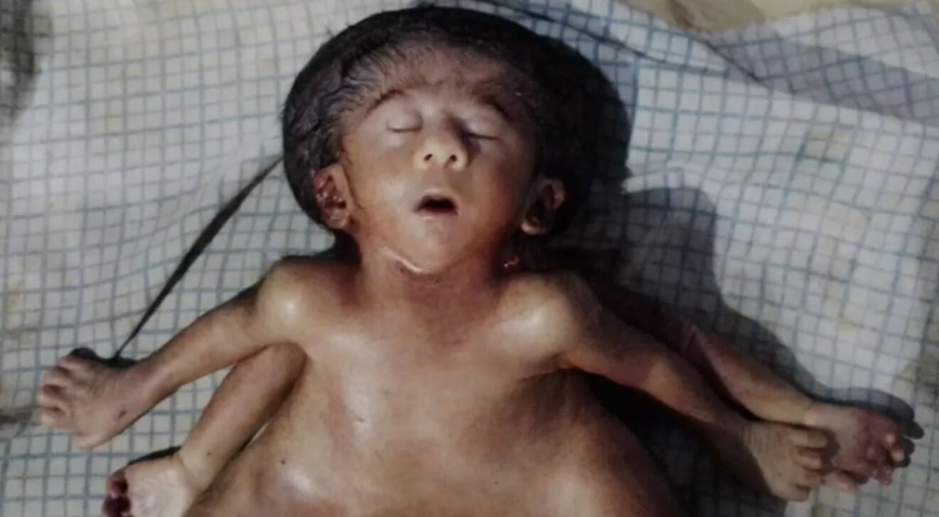 Baby girl born with four hands and four legs (1)