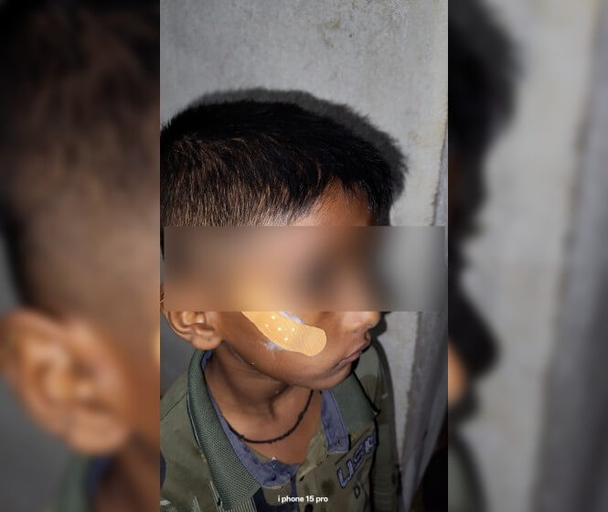 nurse applies feviquik on the cheek of 7 year old Karnataka Adoor 2 (1) (1) (1)